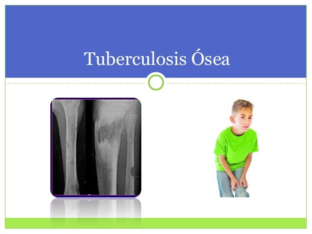 tuberculosis osea